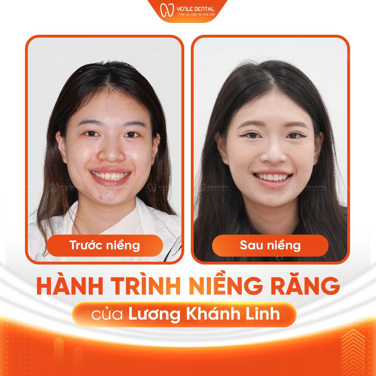 Niềng răng uy tín Hải Phòng - Yenle Dental